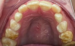 Chalky Teeth