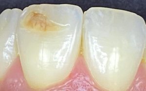 Chalky Teeth