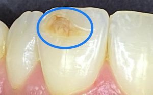 Chalky Teeth