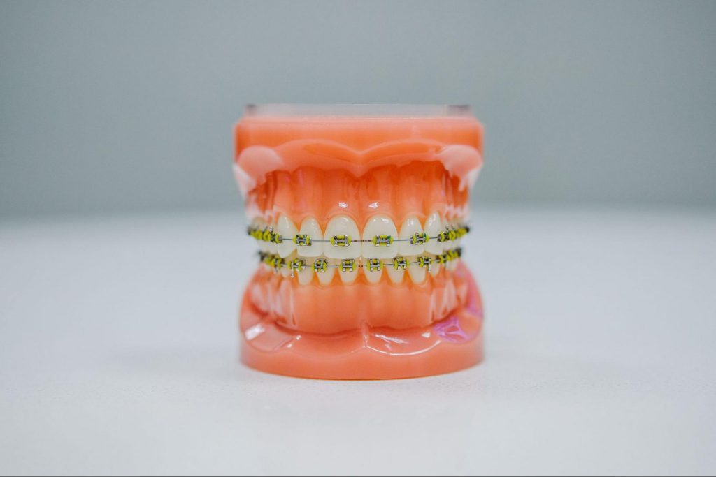 What Are Braces? And What Are The Benefits Of Braces?