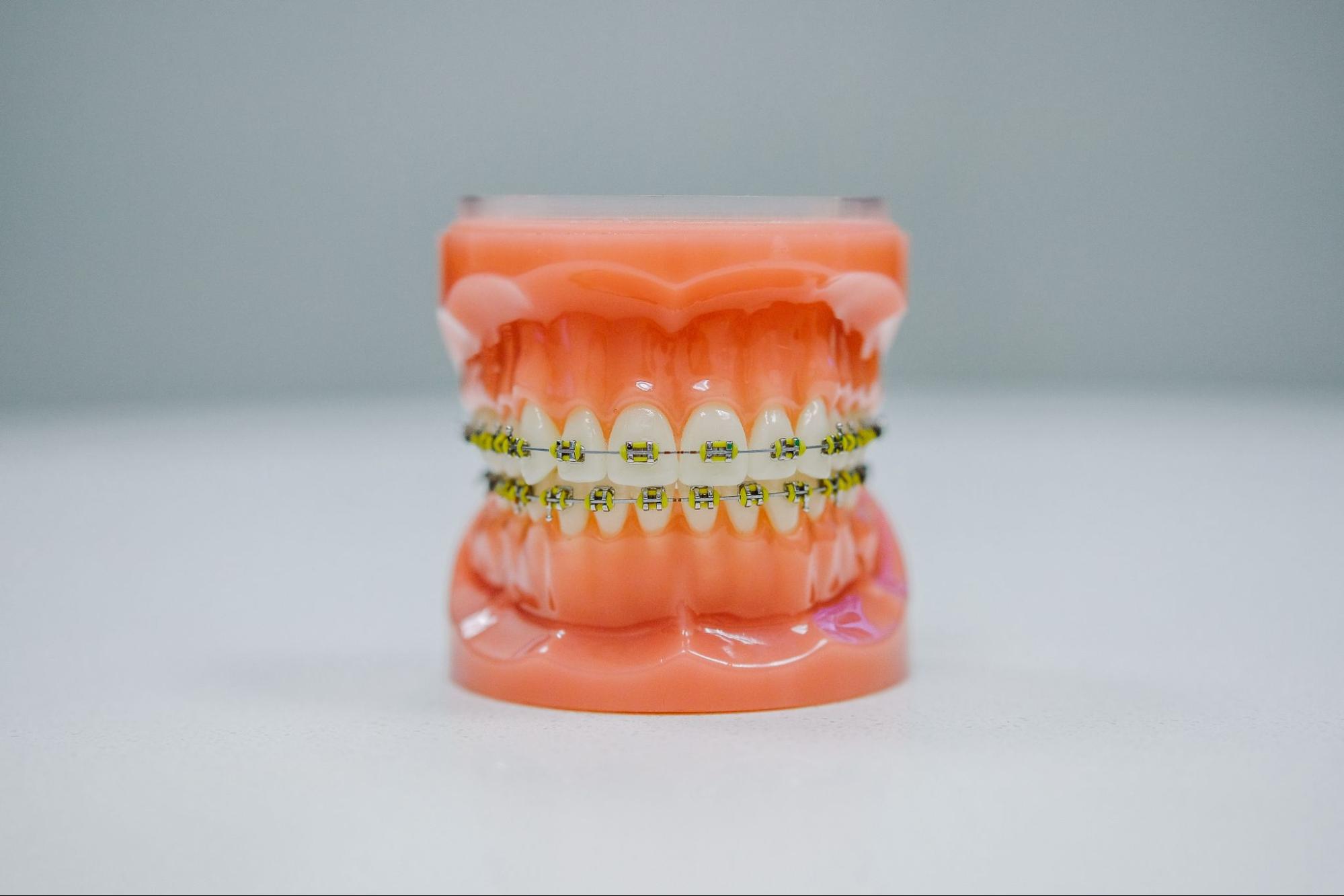 What Are Braces? And What Are The Benefits Of Braces?