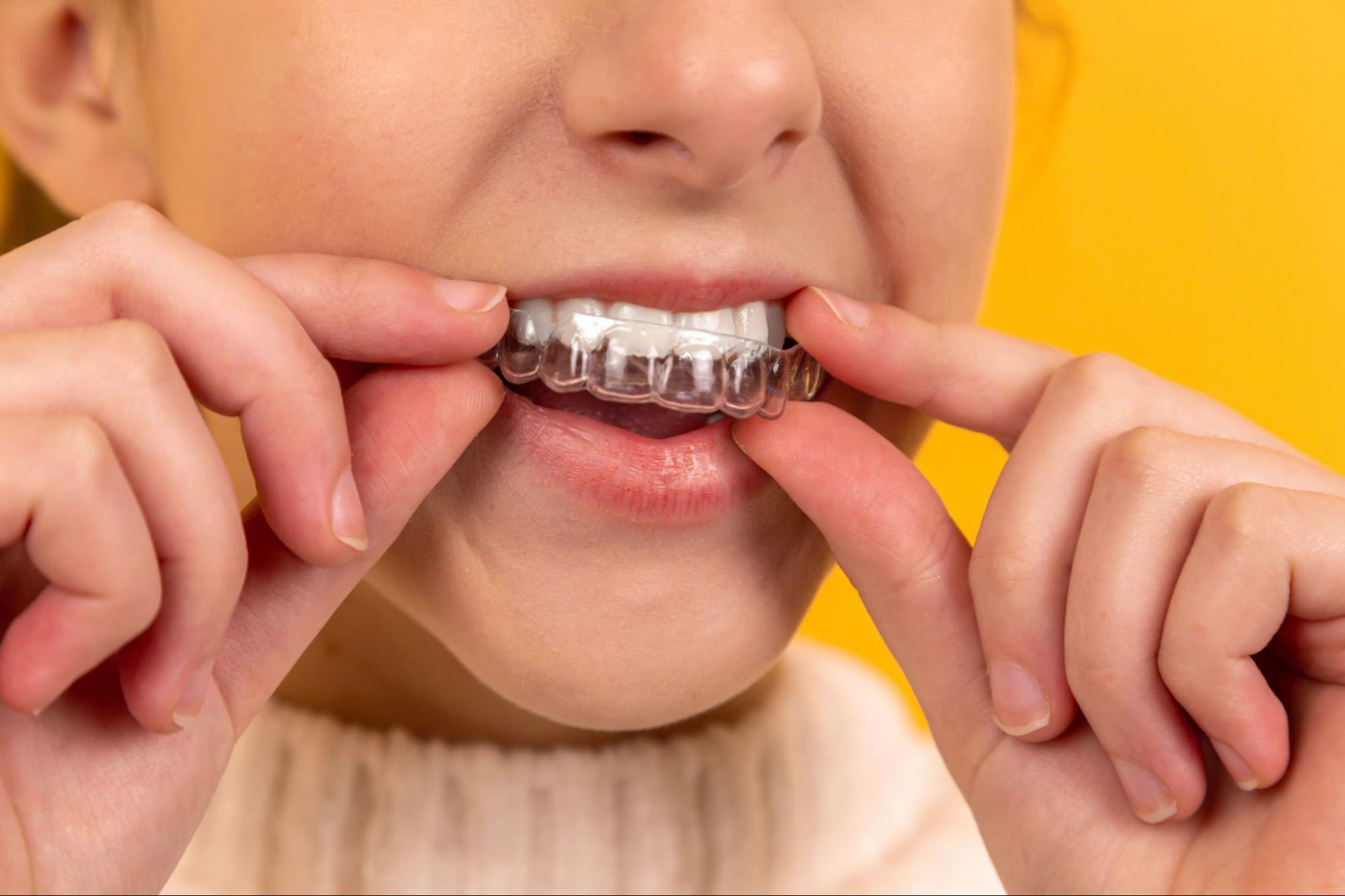 Does Invisalign Work For Crowded Teeth?