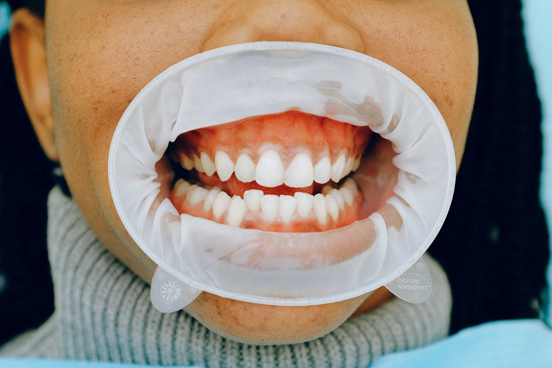 How Exactly Does Teeth Whitening Work?
