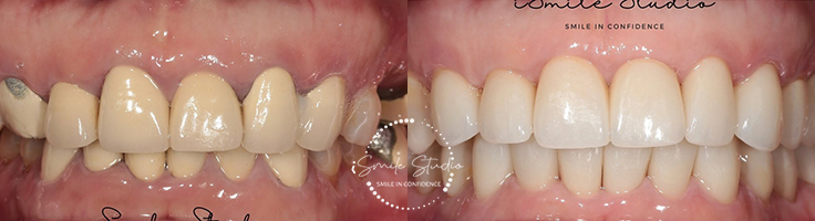 Before After