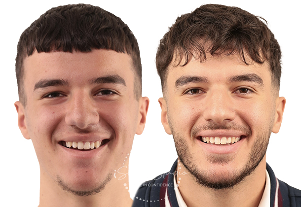 Before After
