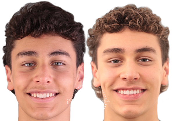 Before After