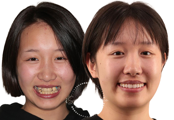 Before After