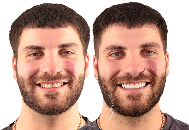 Before After