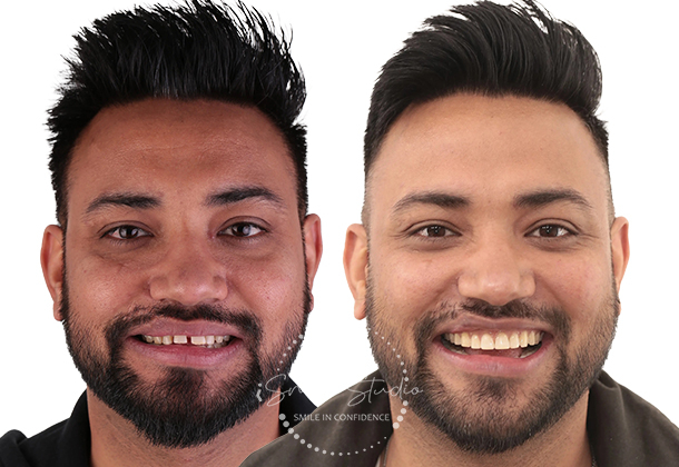 Before After