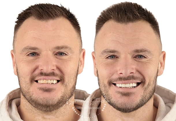 Before After