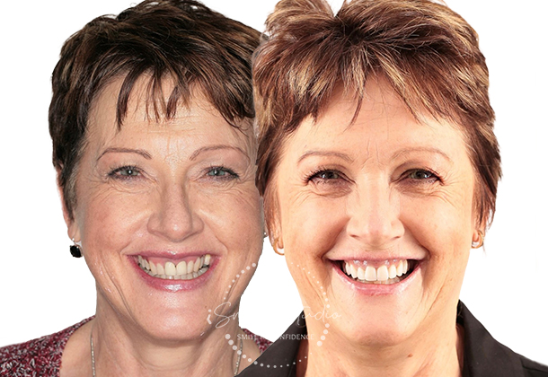 Before After
