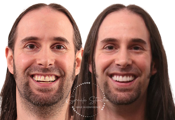 Before After