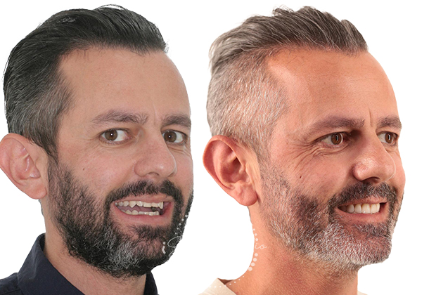 Before After
