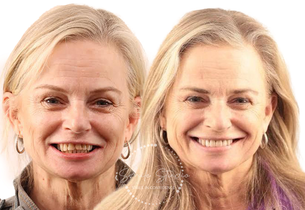 Before After