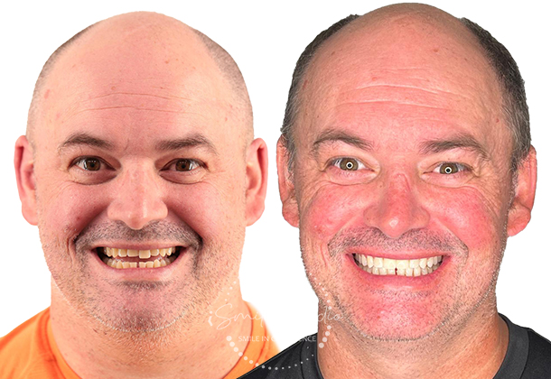 Before After