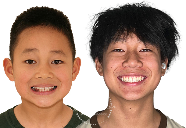 Before After