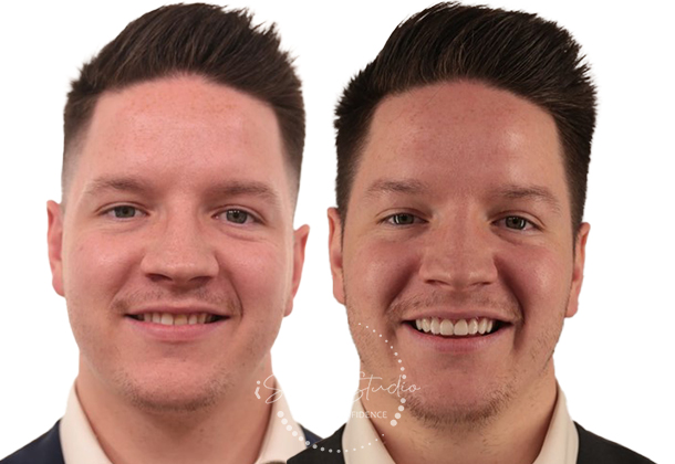 Before After