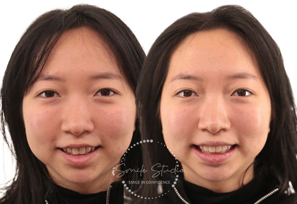 Before After