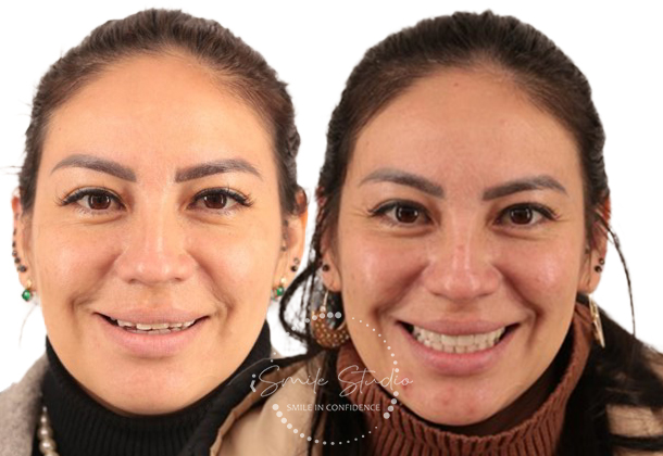 Before After