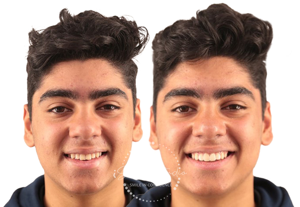 Before After
