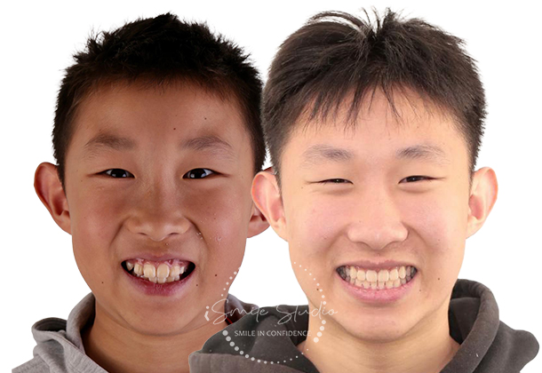 Before After