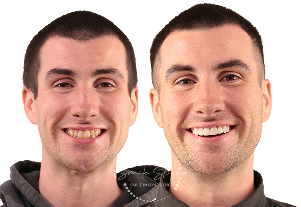 Before After