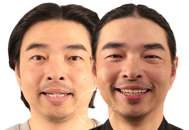 Before After