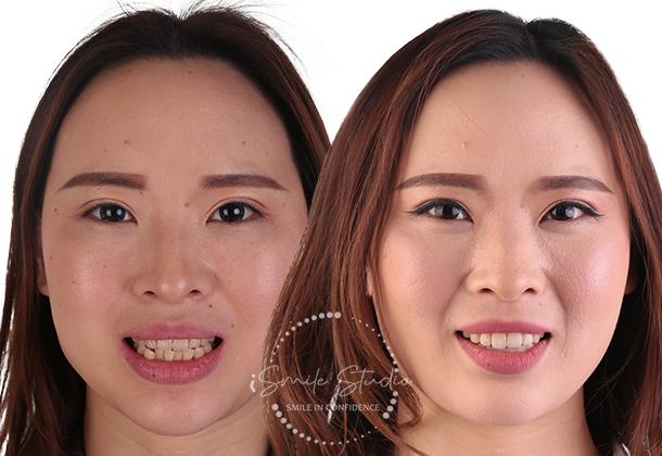 Before After