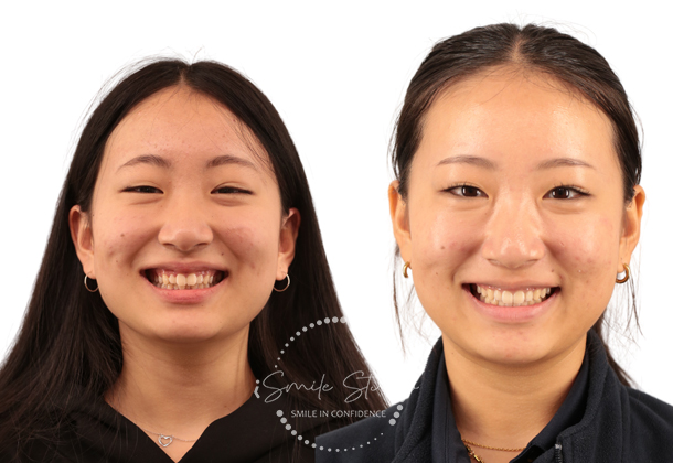Before After