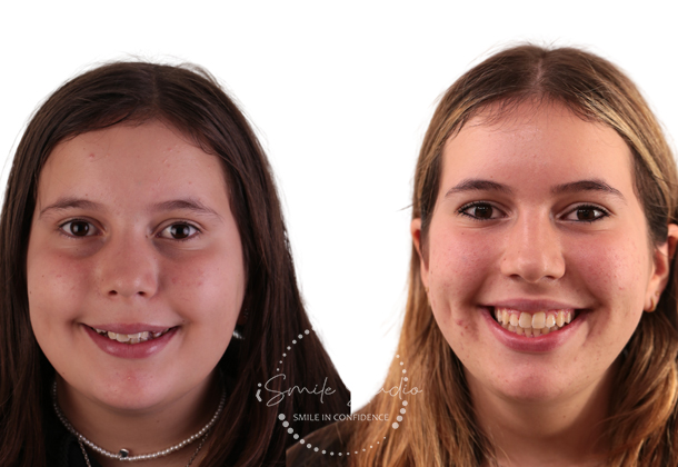 Before After