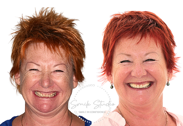 Before After