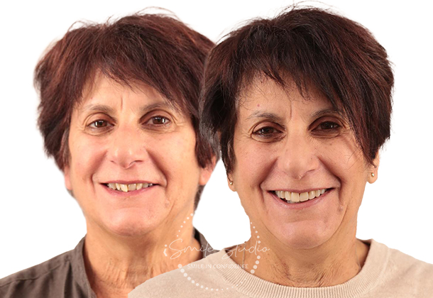 Before After