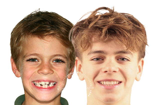 Before After