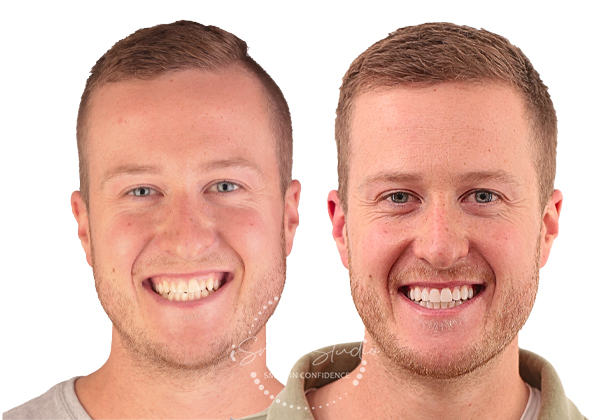 Before After