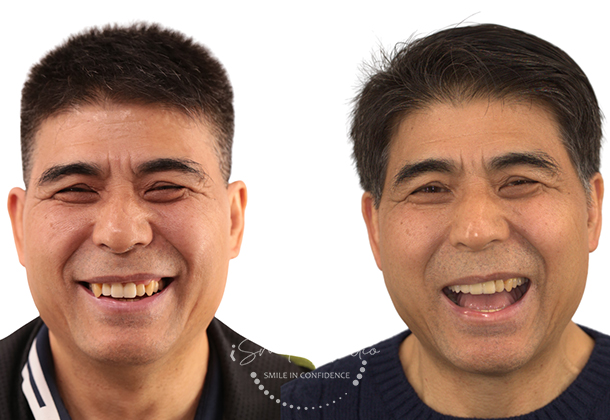 Before After