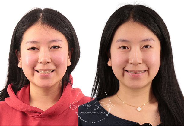 Before After