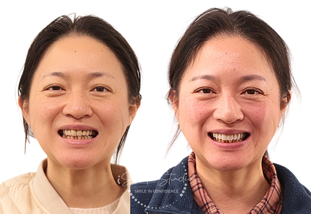 Before After