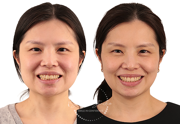 Before After