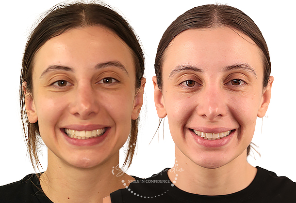 Before After