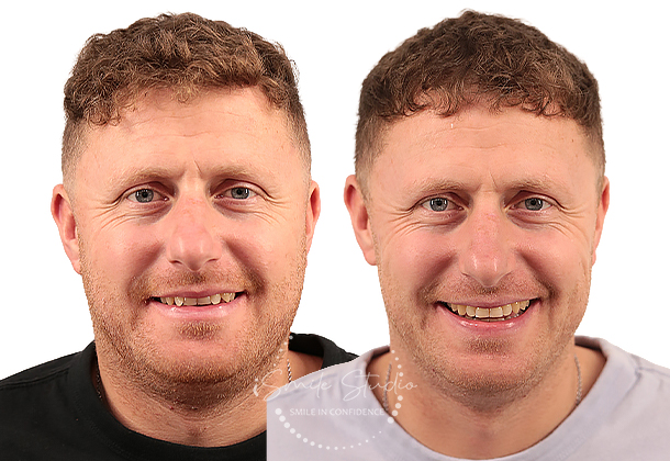 Before After