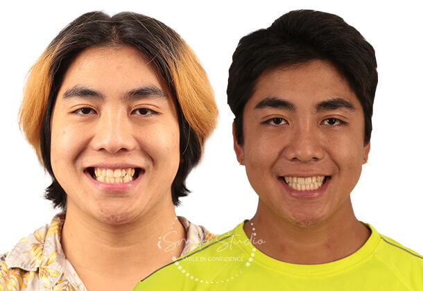 Before After