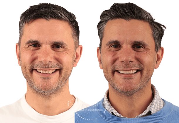 Before After
