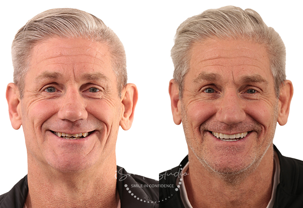 Before After